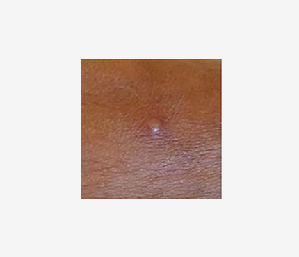 an image of a mpox rash